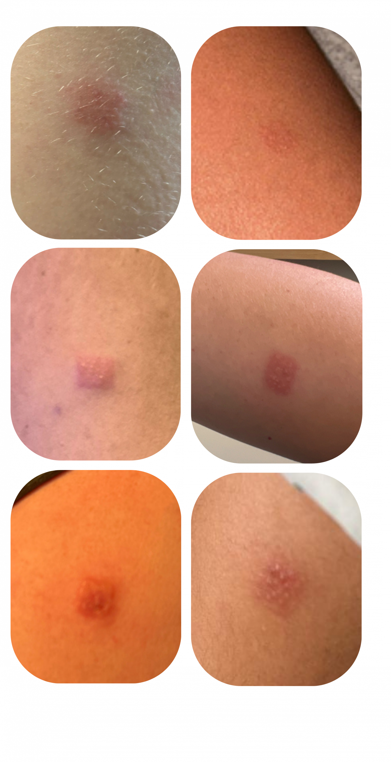 Close-up examples of positive skin reactions identified by consumers using the Colourstart allergy screening system.